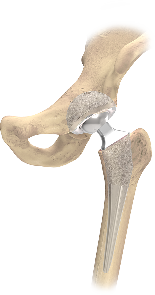 Hip and Knee Implants  United Orthopedic Corporation